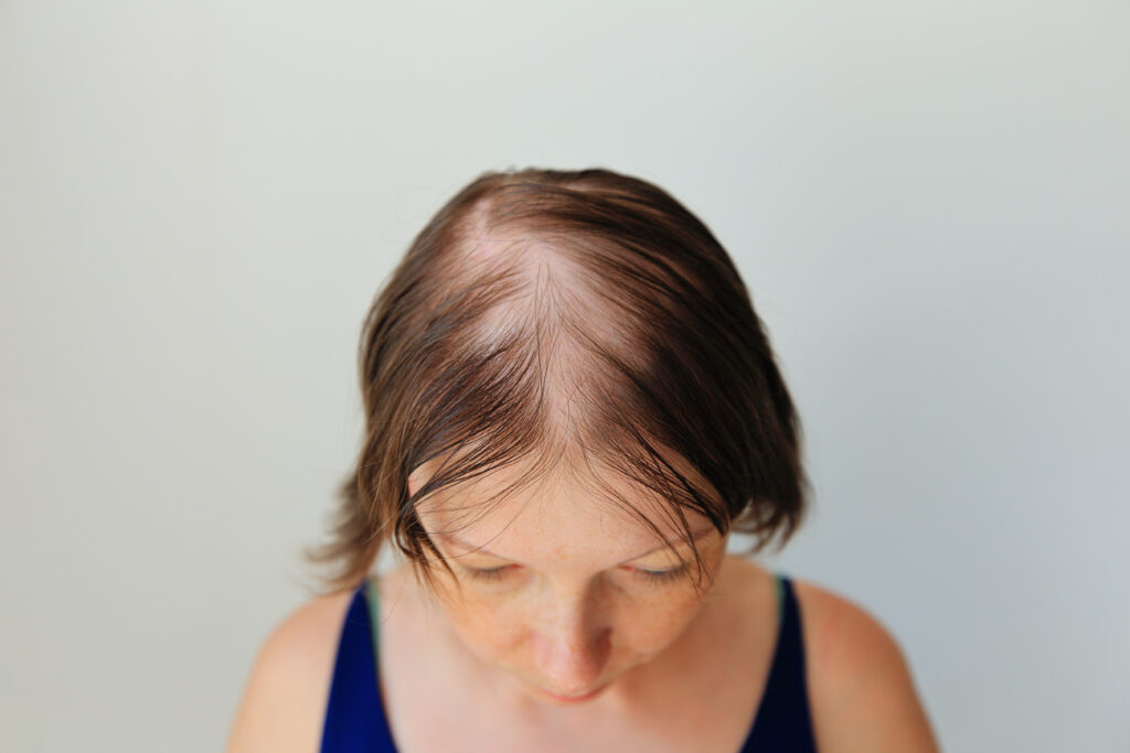 Hajhullás alopecia areata formájában. Egy nő kopasz feje. Hajvékonyodás.
