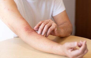 Homeopátiával az Övsömör (Herpes zoster) ellen