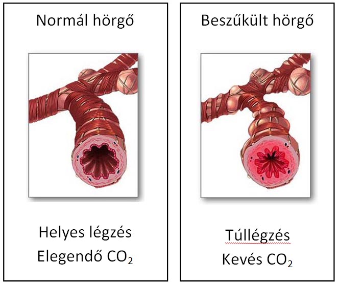 Beszűkült és normál hörgő ábrázolása.