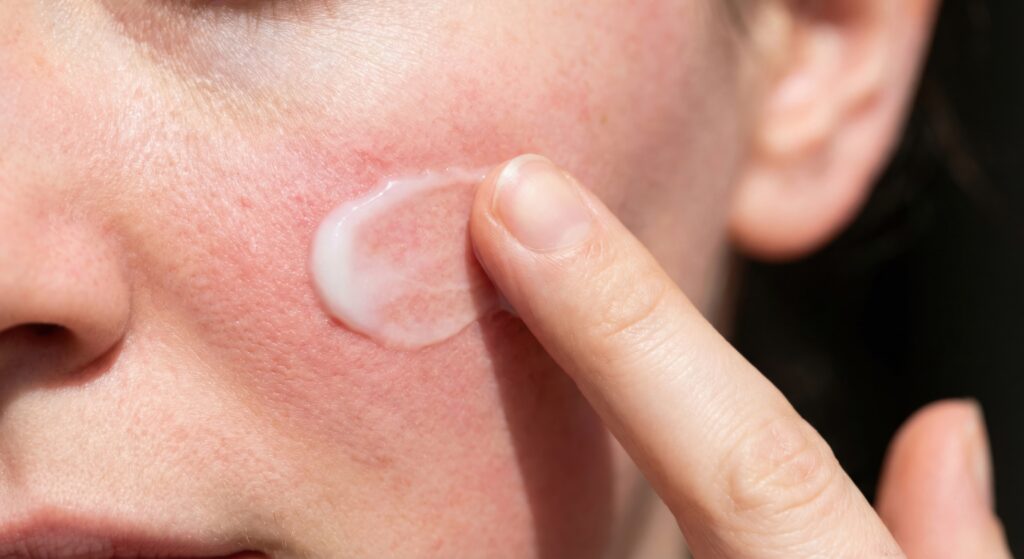 Rosacea-s bőr ápolása krémmel.