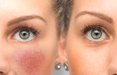 A rosacea, mint autoimmun betegség?